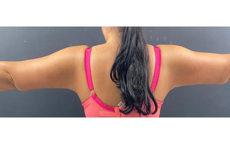 arm-after-1 arm-after-1