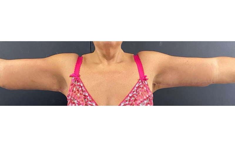 arm-after-2 arm-after-2