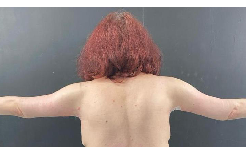 arm-after-3 arm-after-3