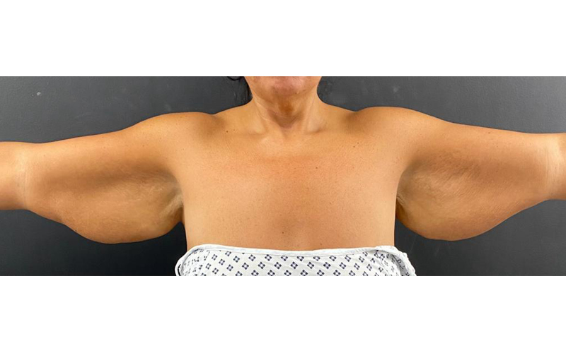 arm-before-2 arm-before-2